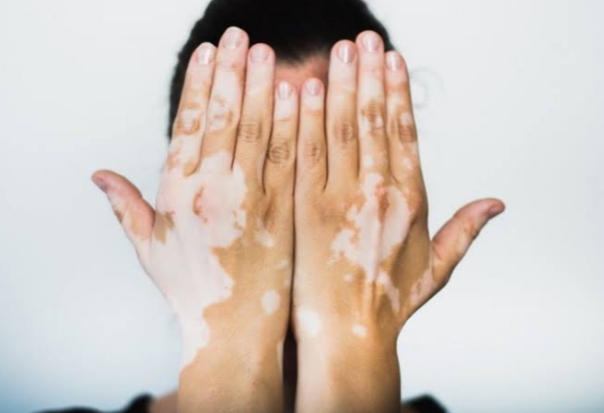 symptoms of vitiligo